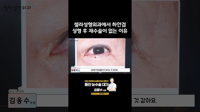 셀라성형외과에서 하안검 성형 후 재수술이 없는 이유