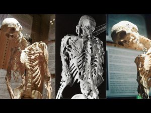 Что такое синдром каменного человека | Перевод DeeAFilm