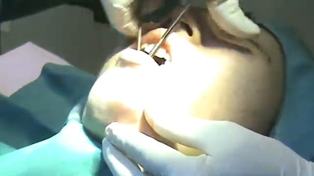 Chin Implants смотреть онлайн