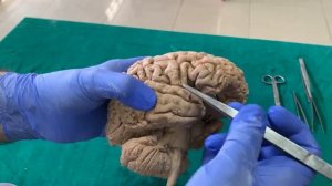 Dissection - Sulci & Gyri of Superolateral surface of brain