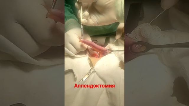 аппендэктомия