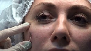 Канюлей корректируем медиальный угол глаза