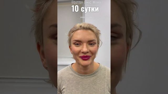 Височный лифтинг. Верхняя блефаропластика. Доктор КОЗЛОВ В.В.