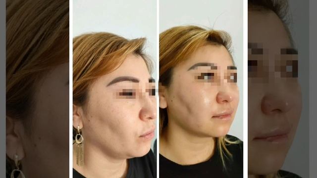 Результаты косметологии Alhayaa смотреть онлайн