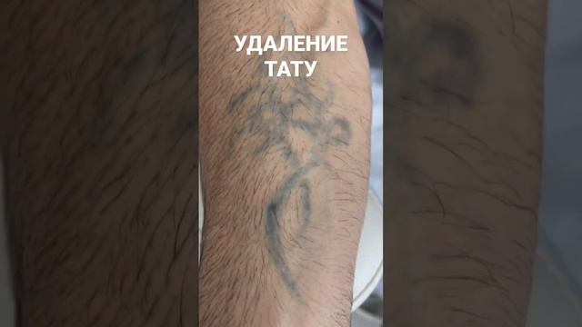 Удаление татуировок смотреть онлайн