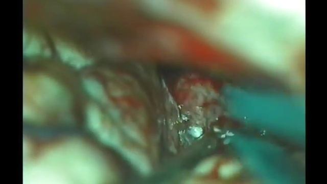 Удаление менингиомы бугорка турецкого седла. смотреть онлайн