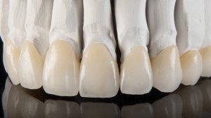 Нужно ли покрывать зуб коронкой после удаления нерва?