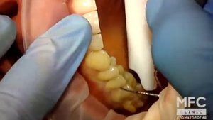 Установка коронок на верхние боковые зубы