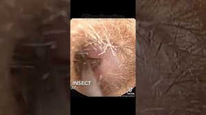 когда в ухо забралась уховёртка двухвостока