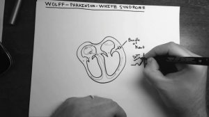 Синдром WPW (Вольфа-Паркинсона-Уайта) | ЭКГ