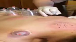 Хиджама для женщин в Москве специалистка с большим опытом