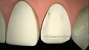 Виниры для зубов. Что это такое?  Как устанавливают виниры.