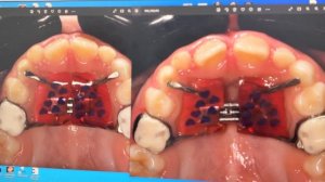 Что такое аппарат Хааса. Рассказывает стоматолог-ортодонт Зубаирова А.  В.