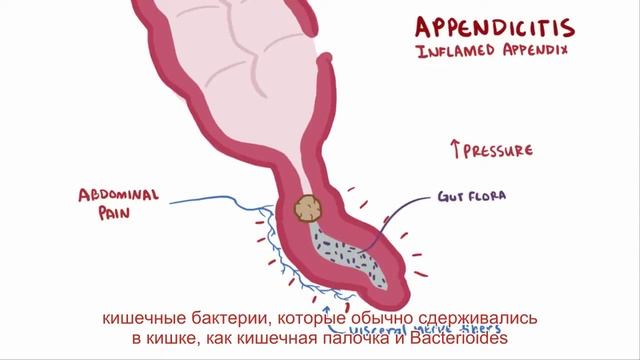 Аппендицит- причины симптомы диагностика лечение с русскими субтитрами