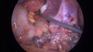 Лапароскопическая аппендэктомия. Гангренозный аппендицит.Инфильтрат5