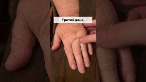 Клинический случай: пациент с лимфостазом левой руки