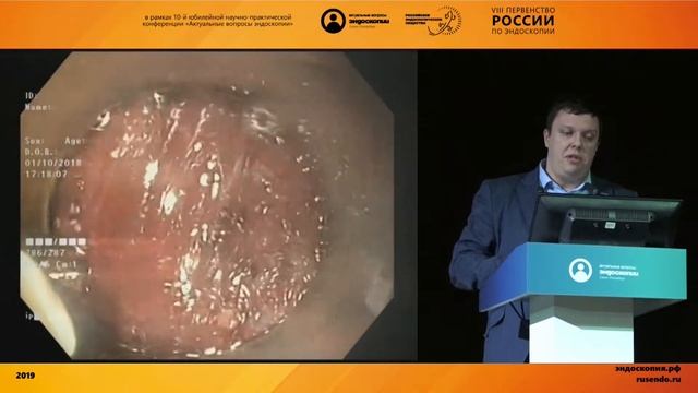 «Никогда не говори никогда» - удаление подслизистого новообразования пищевода смотреть онлайн