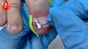 Угол ногтя врос в боковой валик что делать / Вросший ноготь на ноге / Снова врастает уголок ногтя