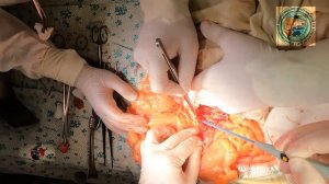 OPEN SIGMOID RESECTION, D3, PRESERV. LCA SRA/резекция сигмовидной кишки Д3, сохранение ЛОА и ВПА.