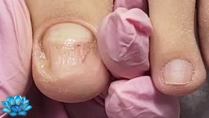 Как делать аппаратный педикюр когда у клиента онихолизис ногтей. #2