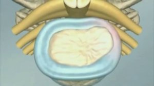 Межпозвонковая грыжа - Процесс формирования