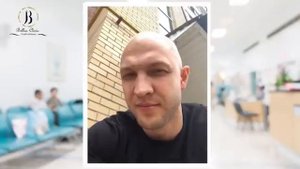 Результат пересадки волос в BELLUS CLINIC, Сергей из России