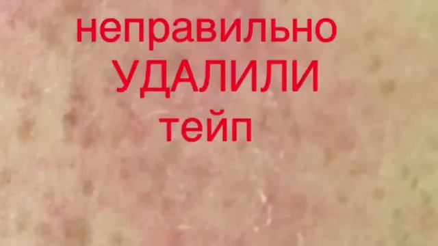 Тейпирование. Реакция на тейп смотреть онлайн