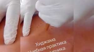 Ручка для хиджамы, иглоручка