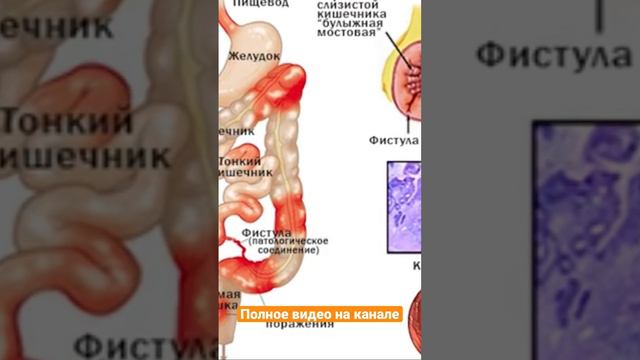 14 Признаков того, что Толстая КИШКА ОТМИРАЕТ