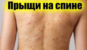 Как убрать прыщи на спине в домашних условиях - Быстрый рецепт от прыщей