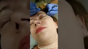 Блефаропластика снятие швов