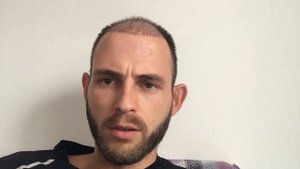 Выпадают волосы после пересадки волос ?  Без паники!