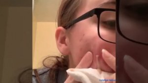 ВЫДАВЛИВАНИЕ ПРЫЩЕЙ, ГНОЙНИКОВ, УГРЕЙ, ЧЁРНЫХ ТОЧЕК, МАЗОЛЕЙ