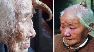 Рога у людей: феномен подозрительный для просто болезни