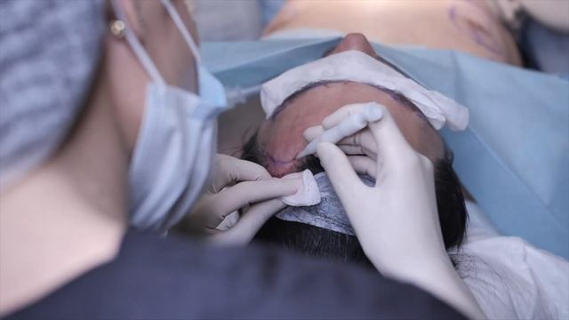 Пересадка волос в Киеве | Трансплантация волос в клинике Lita Plus смотреть онлайн