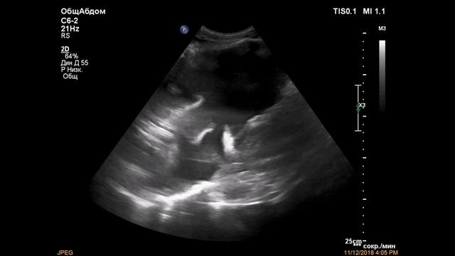 Лимфосаркома средостения с распространением на забрюшинное пространство смотреть онлайн