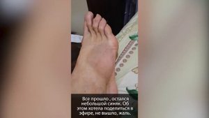 23. Подвернула ногу и упала. Нога распухла и посинела. Одела Artraid. Изделия Артрейд.