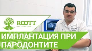 ? Можно ли проводить имплантцию при пародонтите. Имплантация при пародонтите