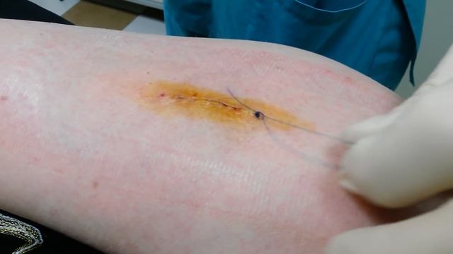 Снятие косметического шва после удаления липомы смотреть онлайн