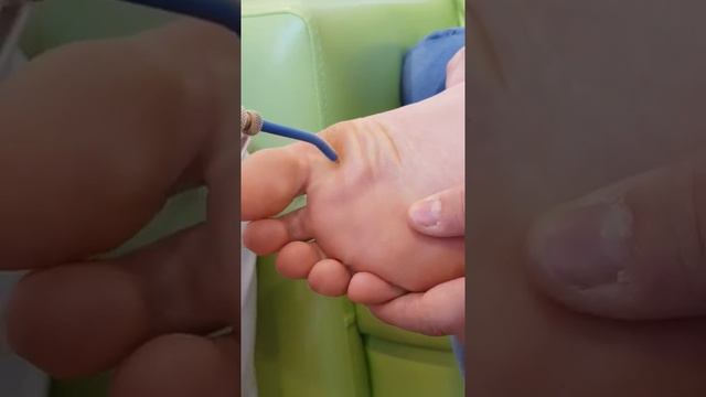 Криодеструкция подошвенной бородавки.