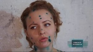 Ветрянка у взрослых