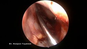 Закрытие перфорации перегородки носа. Nasal perforation surgery. Камран Гаджиев