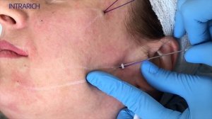 Армирование средней трети лица мезонитями INTRARICH на канюле