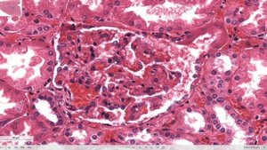 Диабетическая нефропатия | Патологическая анатомия