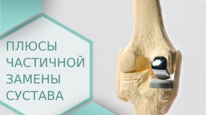 ? Преимущества одномыщелкового протезирования коленного сустава. Одномыщелковое протезирование. 18+