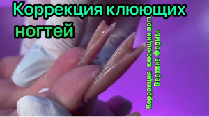 Коррекция клюющих ногтей
