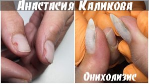 Что будет если переходить с гель-лаком? Последствия гель-лака/ Онихолизис