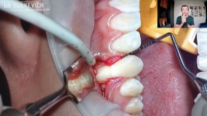 Лечение рецессии десны методом КСЛ // Coronally advanced flap for single gum recession treatment