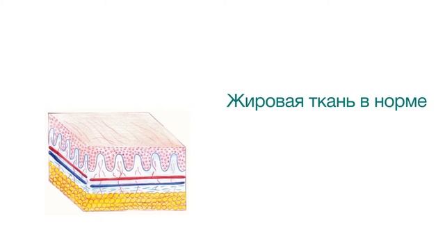 Что такое целлюлит