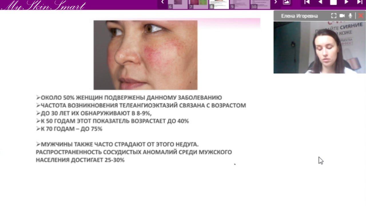 Лекция 11. Купероз. ТАЭ. Розацеа. Периоральный дерматит